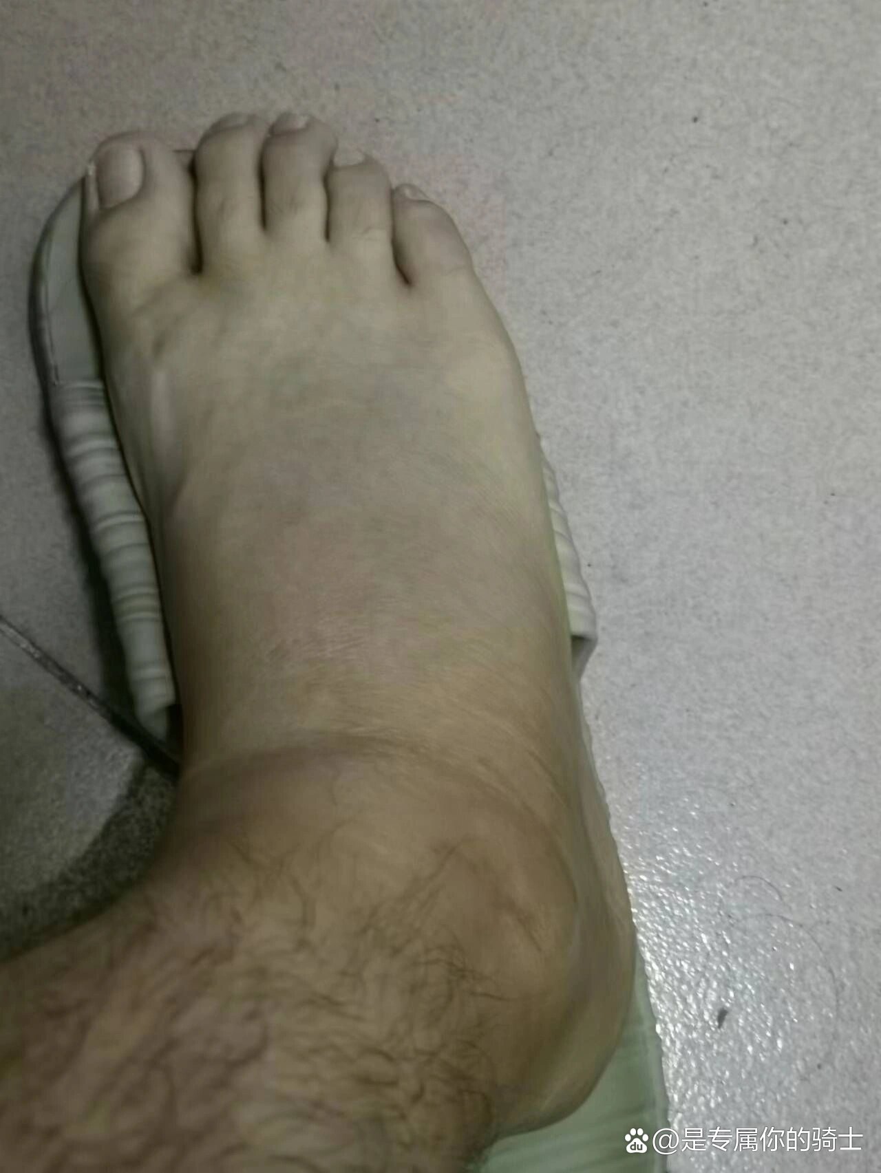 把右脚给崴了,当天晚上就疼的不得了,右脚都不能着地