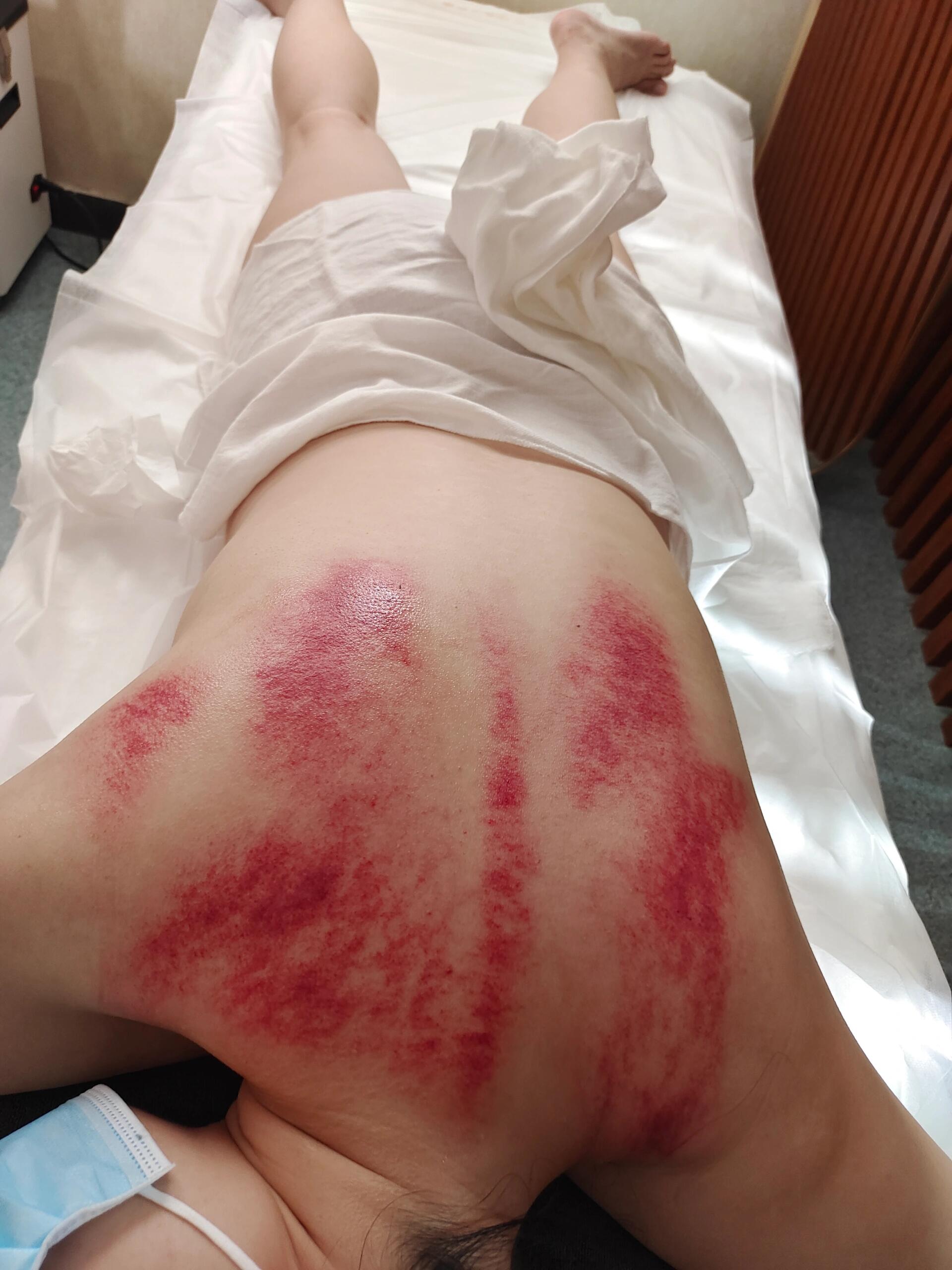 产后肩膀疼,宝妈求助,一次就好多了