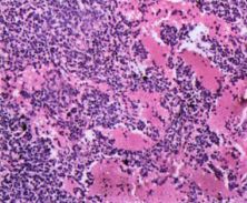 综合治疗毛细胞白血病,帮助缓解乏力,贫血