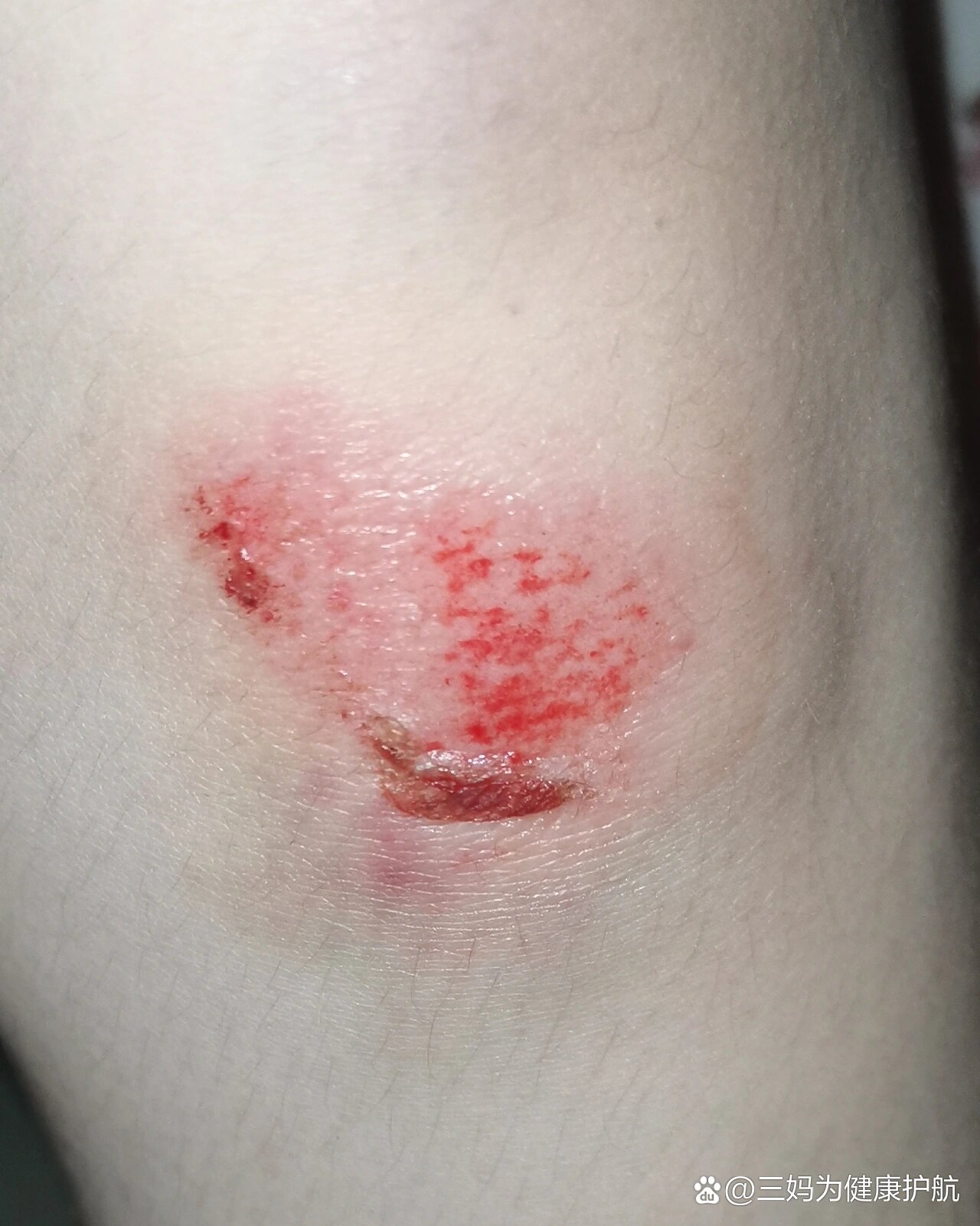 希望磕破的膝盖快点好起来