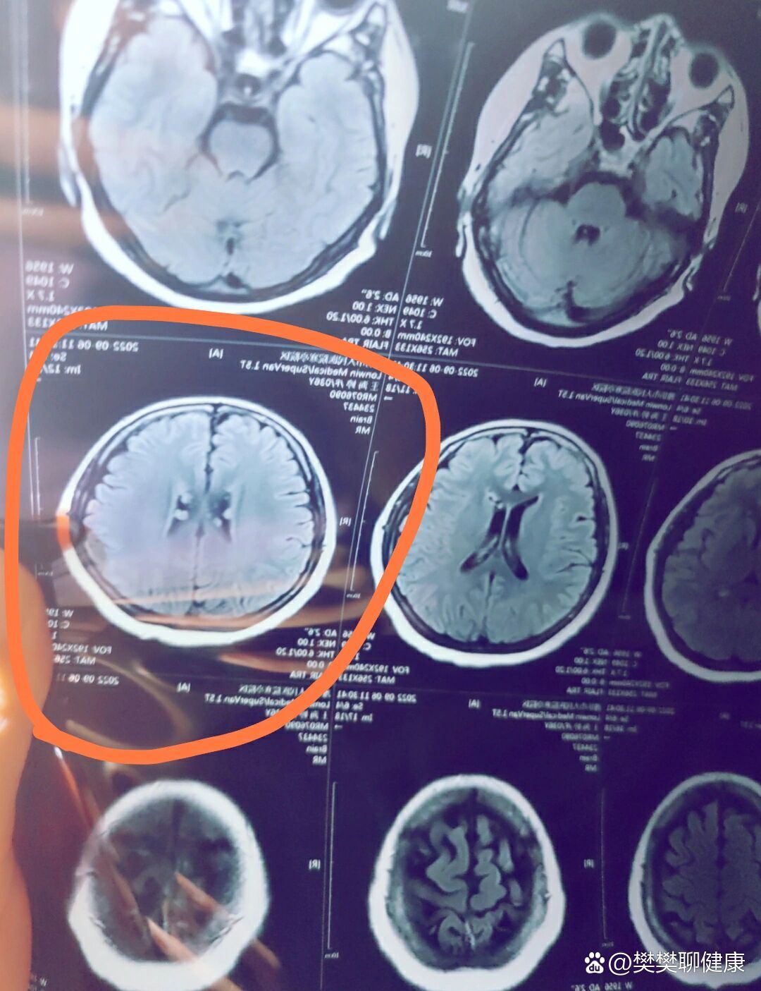 脑部核磁共振,哪位老师可以给看下片子