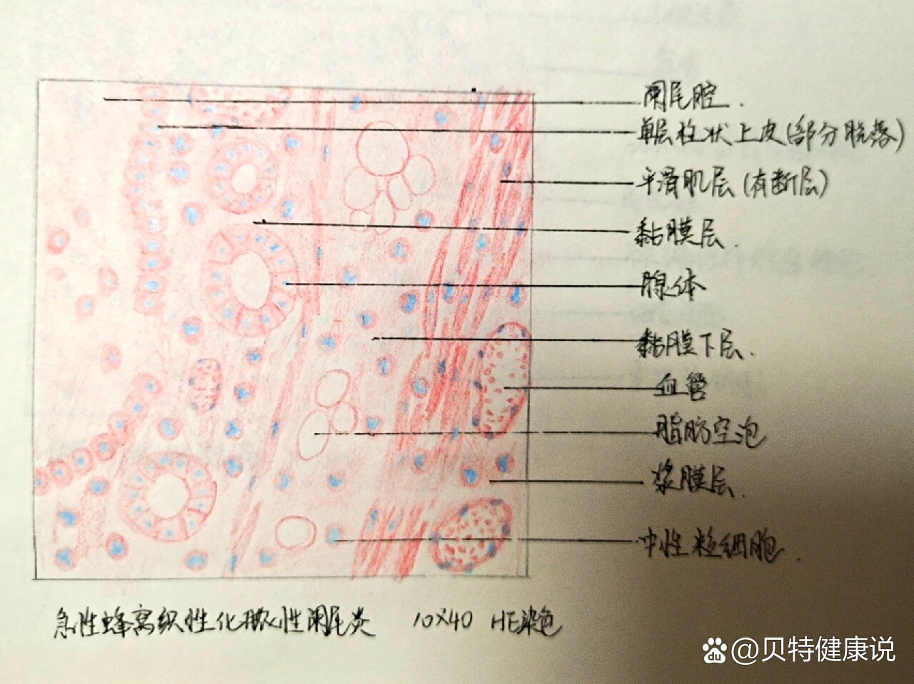 化脓性阑尾炎病理绘图图片