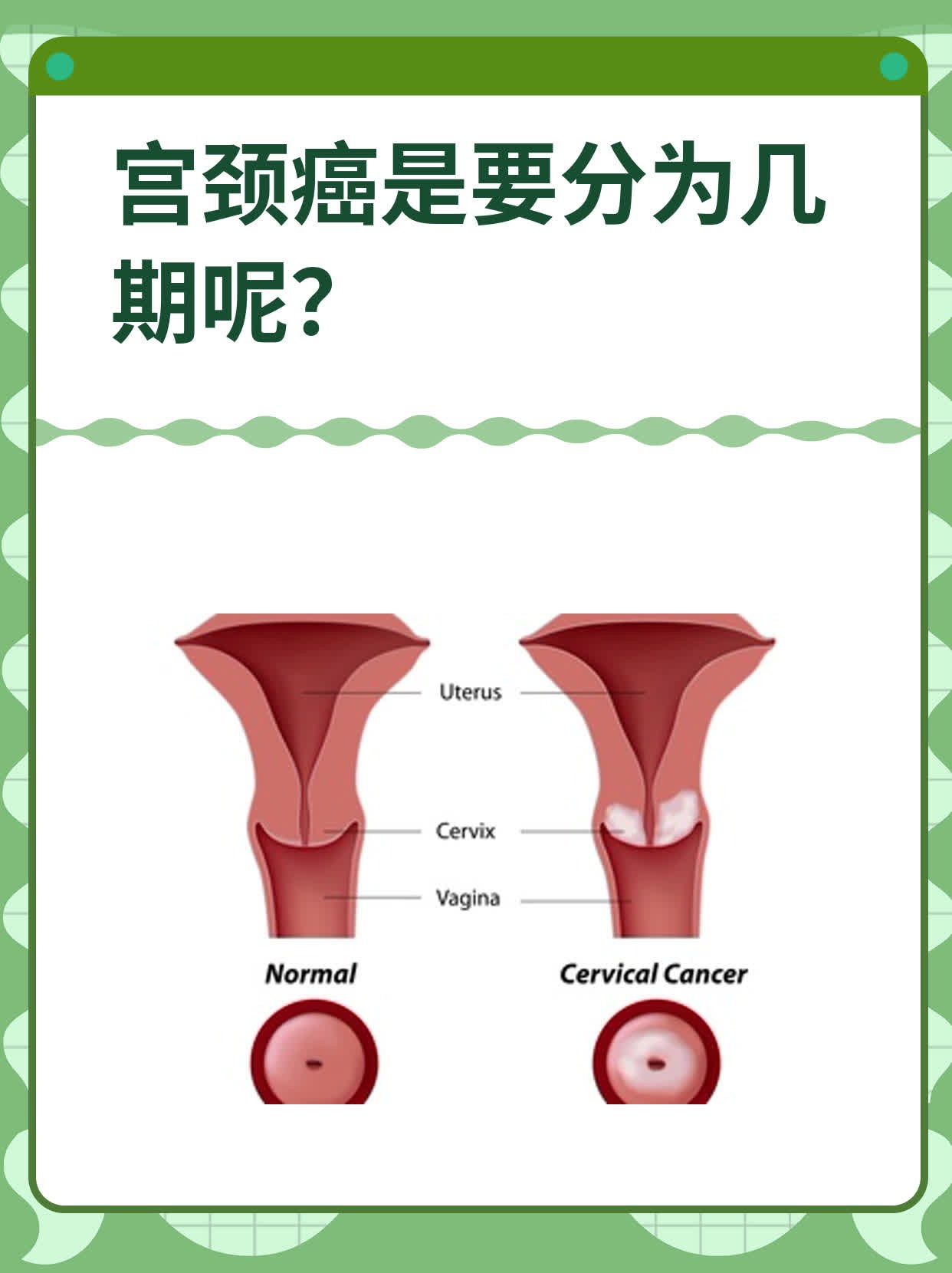 宫颈癌早期黄水下面图片