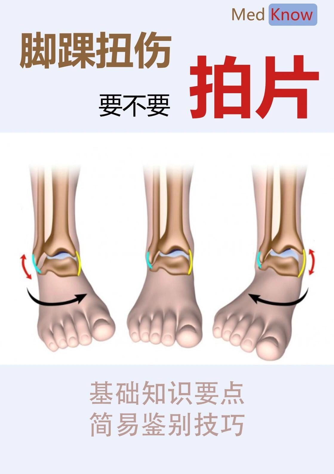 脚踝扭伤后要不要去医院拍片?