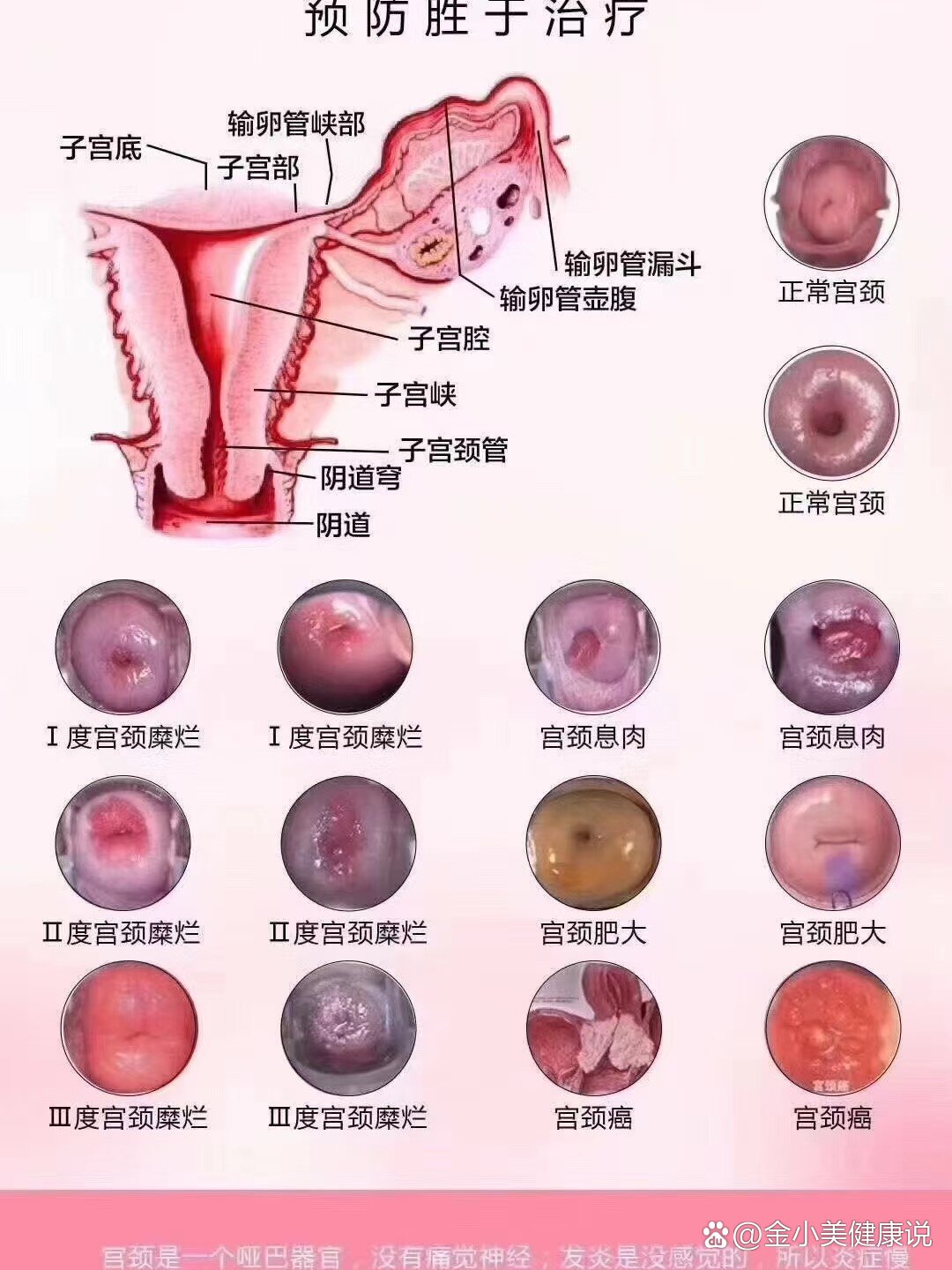 宫颈糜烂1度→2度→3度→hpv阳性→癌前病变→癌