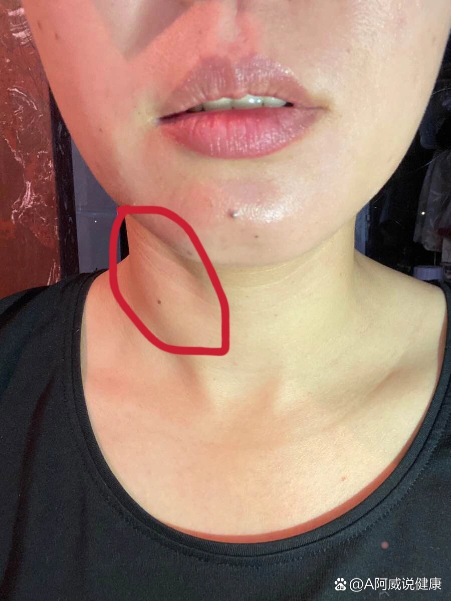 右侧脖子肿,两边不对称,还有凸起