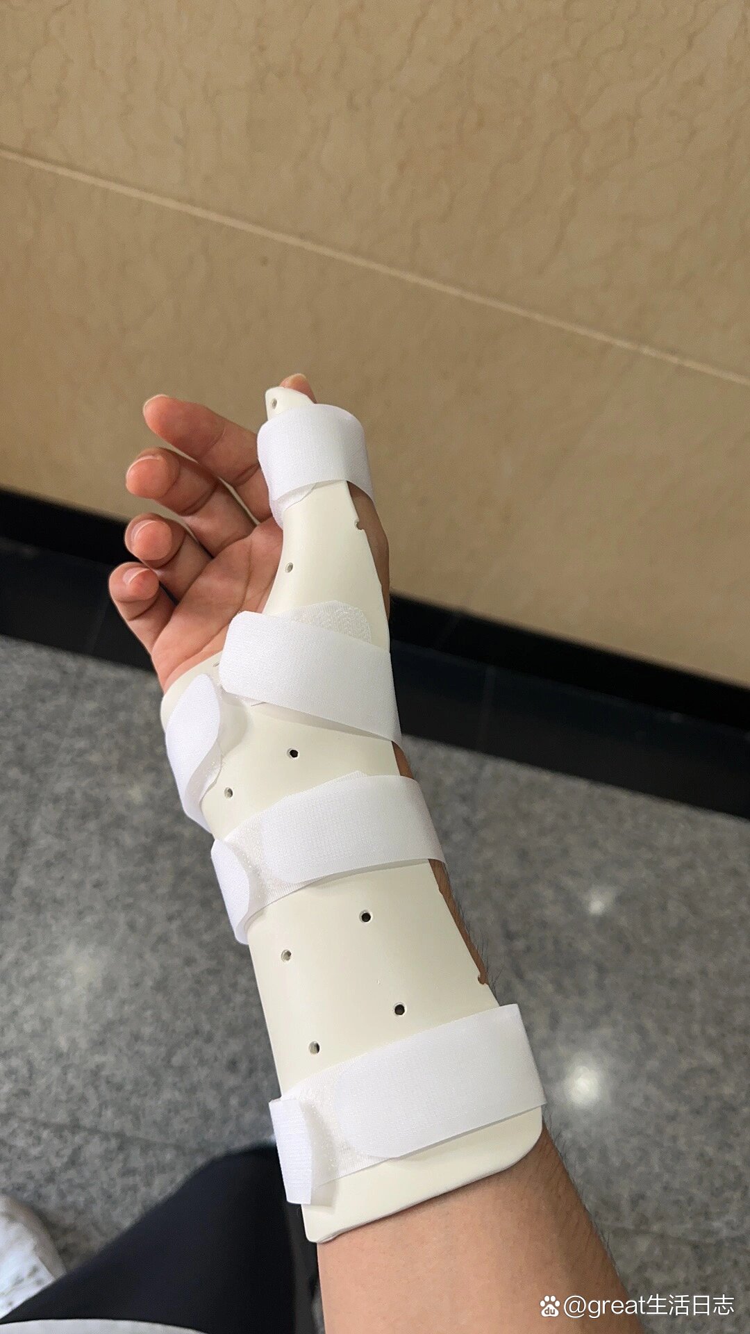 舟骨骨折