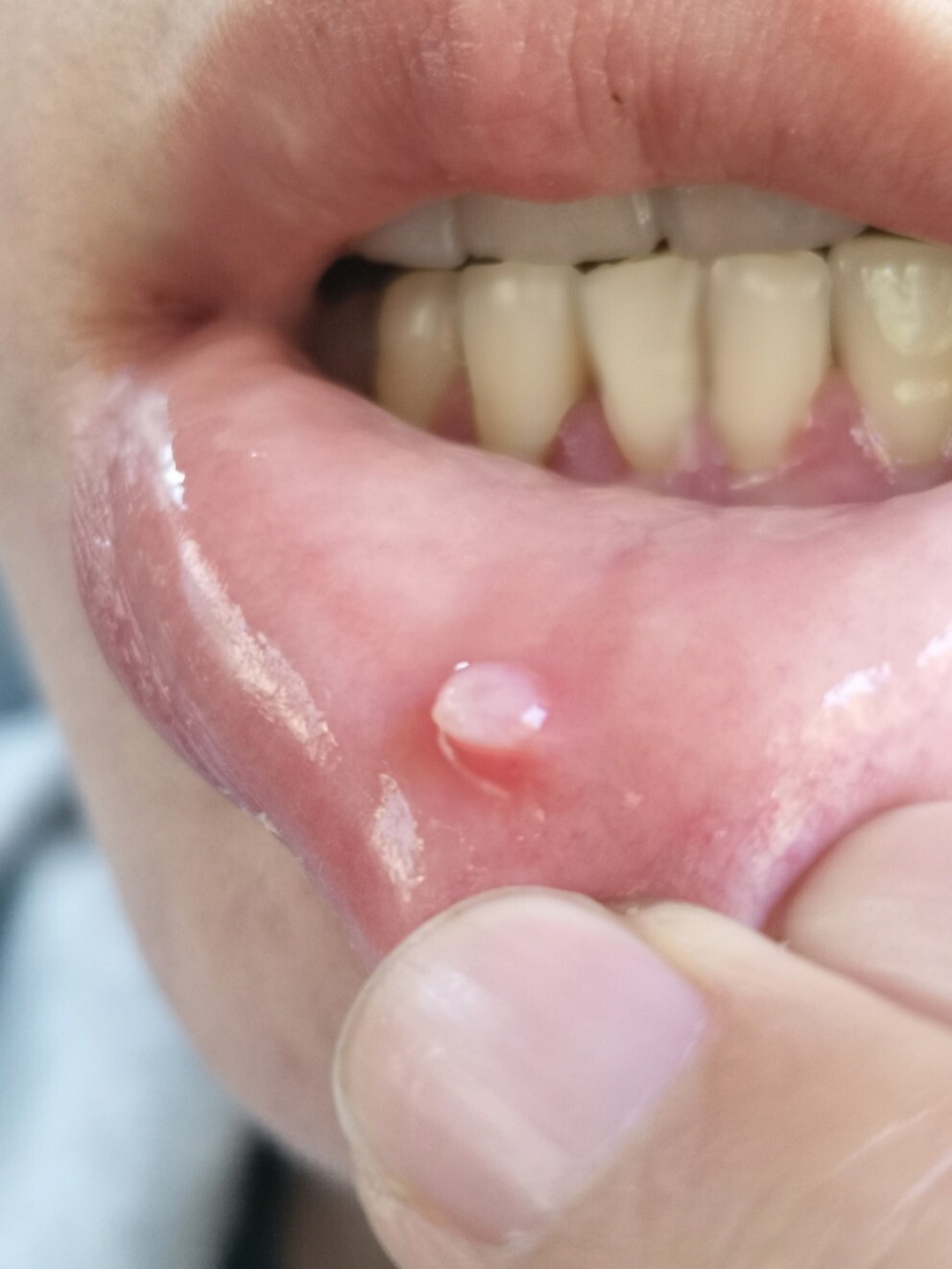 粘液腺囊肿