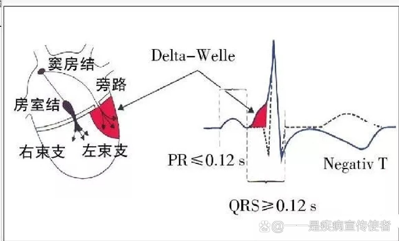 心室预激波心电图特点图片