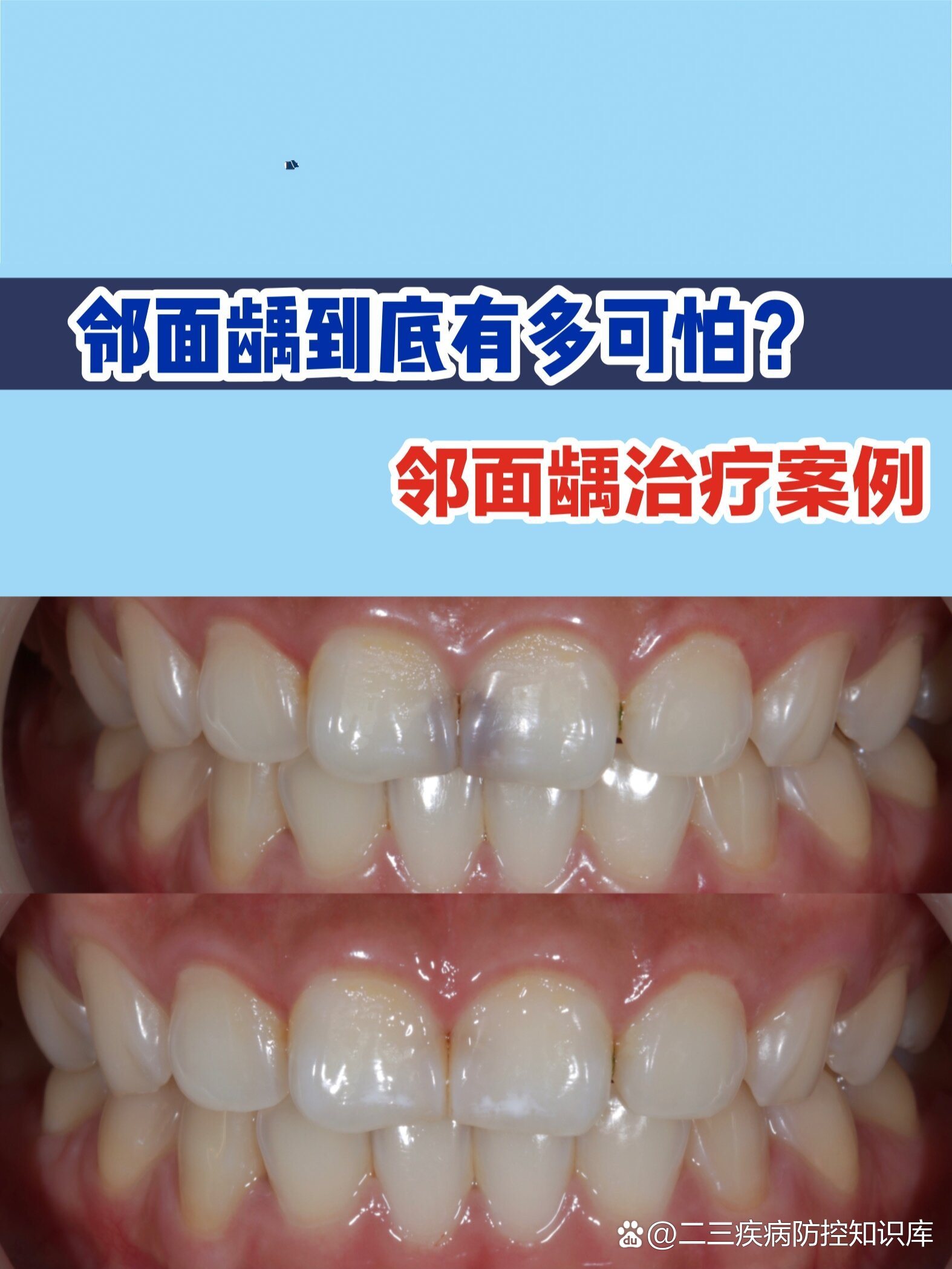  p>我不说你可能都不知道邻面龋有多可怕 br>龋齿就是蛀牙,首先,咱们