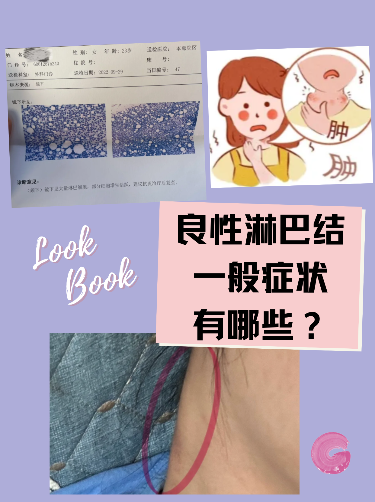 提问!良性淋巴结,一般症状有哪些?