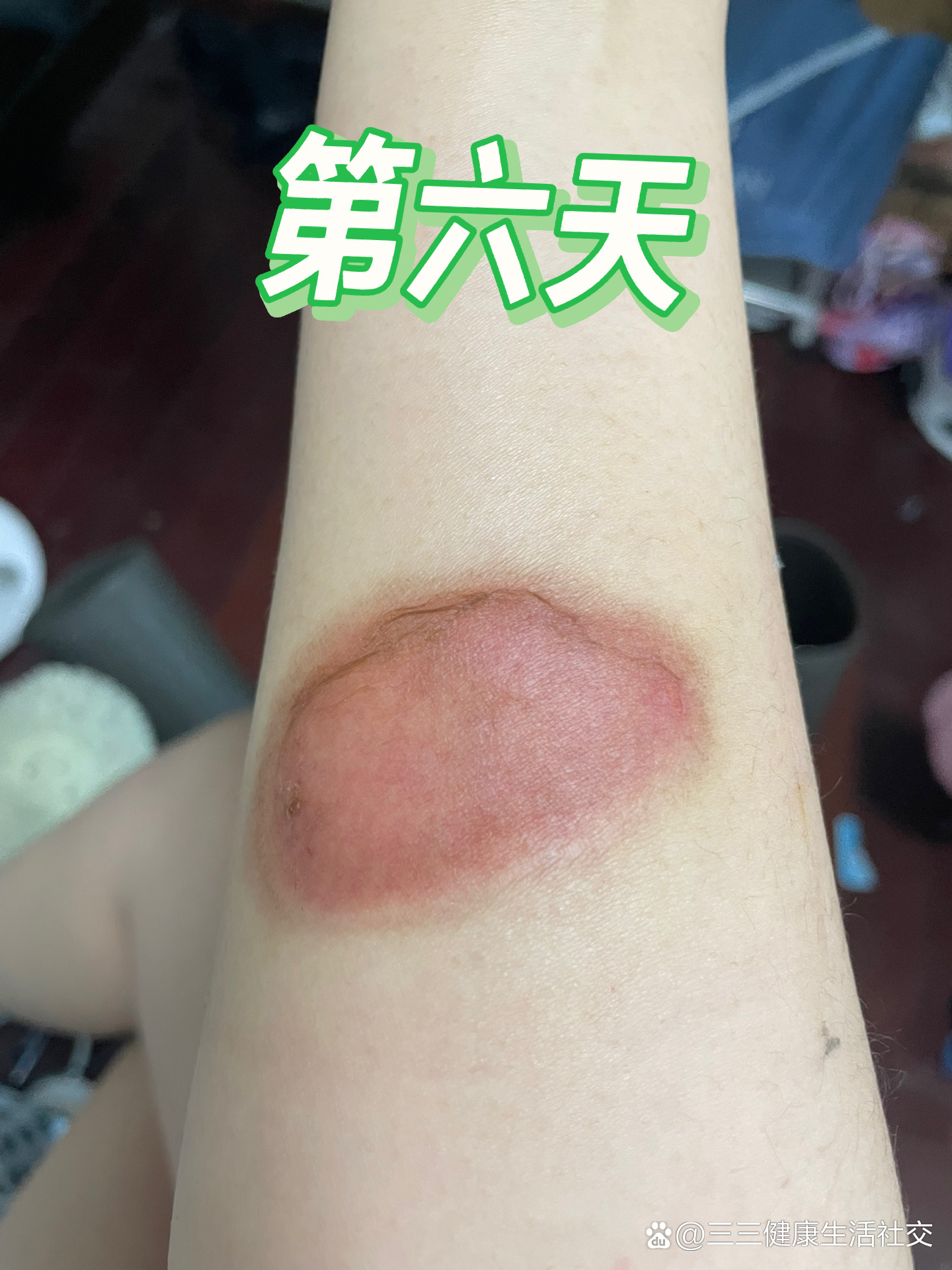 女生胳膊烫伤照片图片