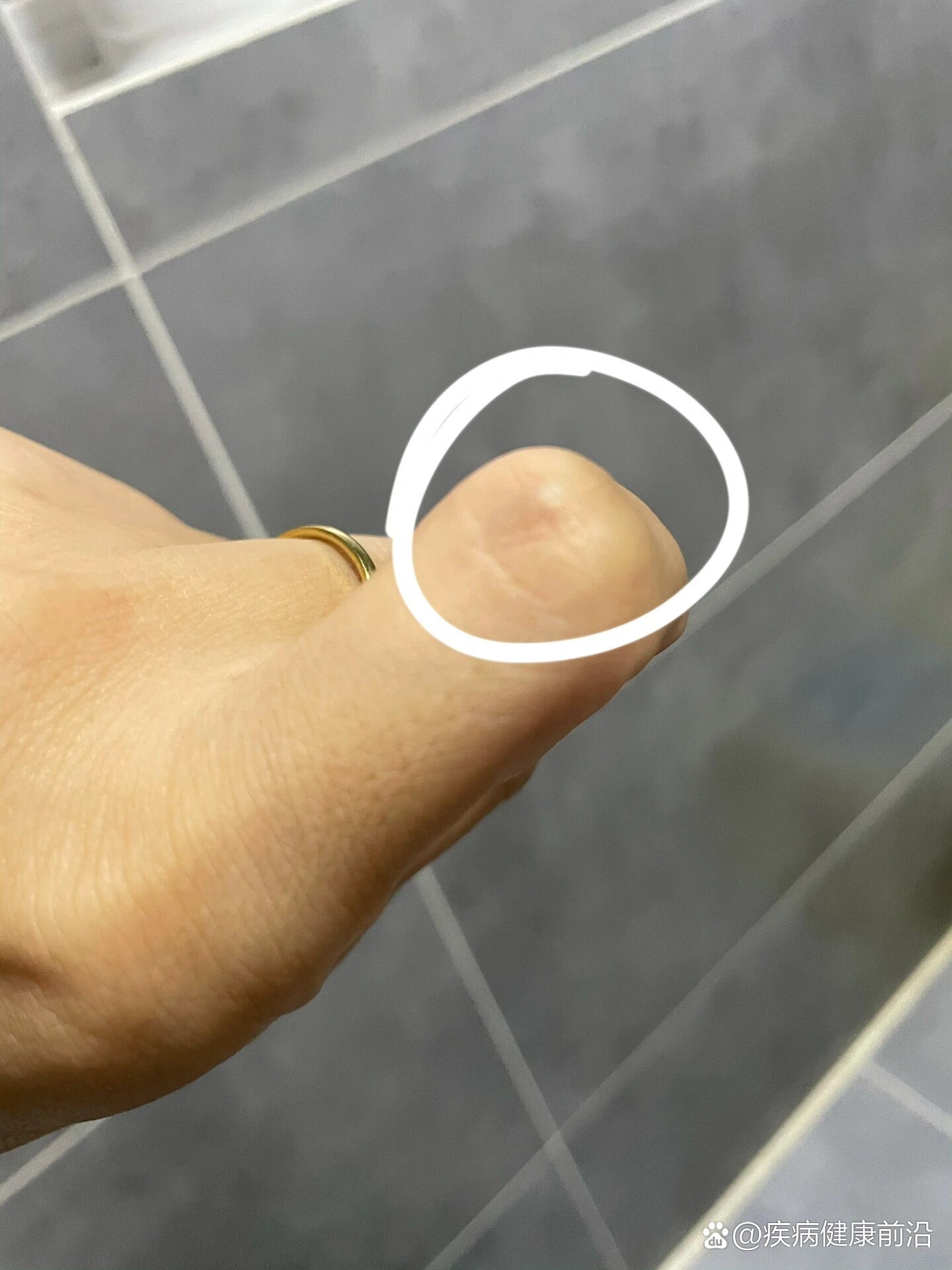 食指关节长了一个小疙瘩