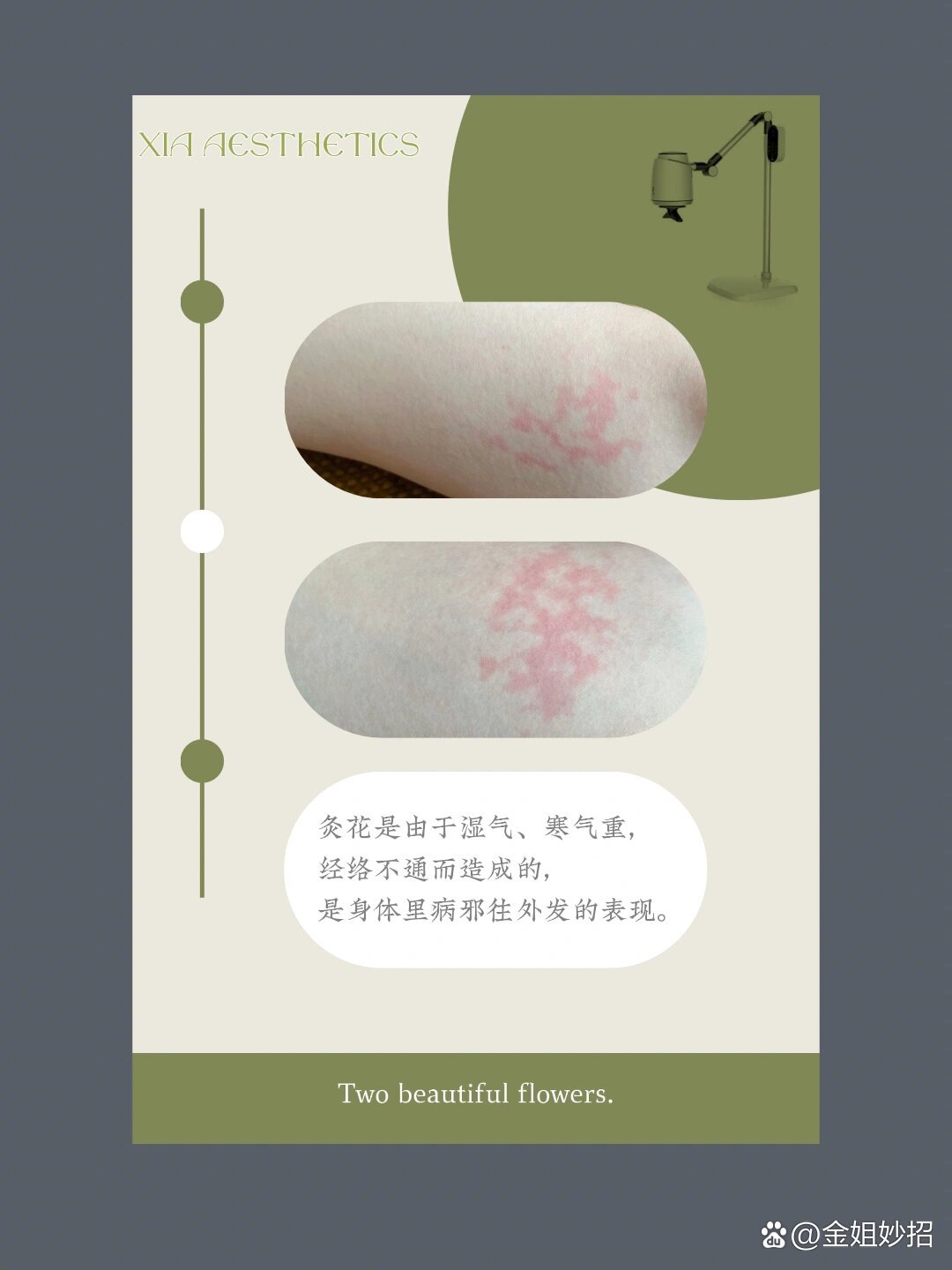 三伏灸/灸花/湿气重/寒气重/经络不通