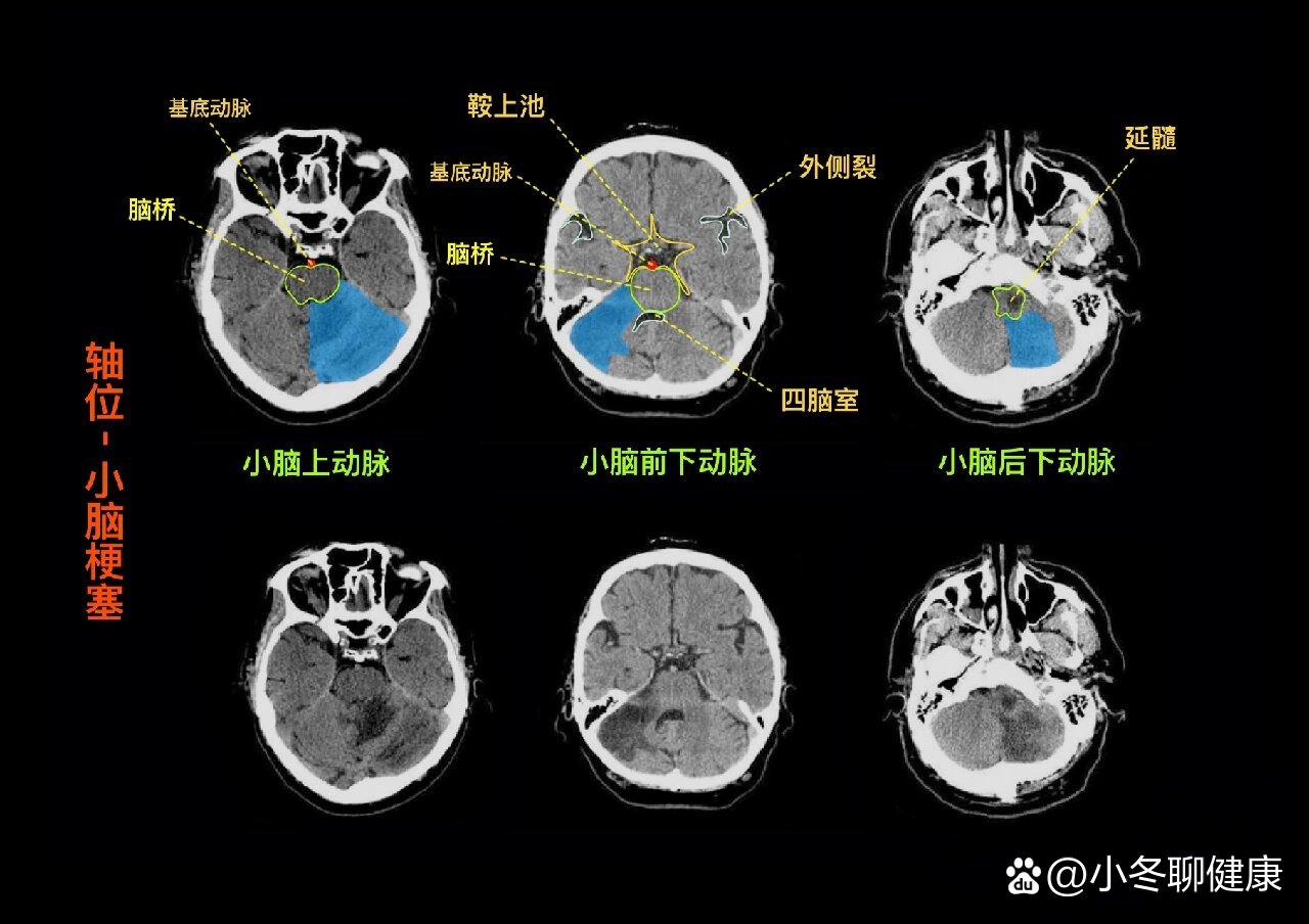 知识点004〗小脑三支动脉梗塞的ct征