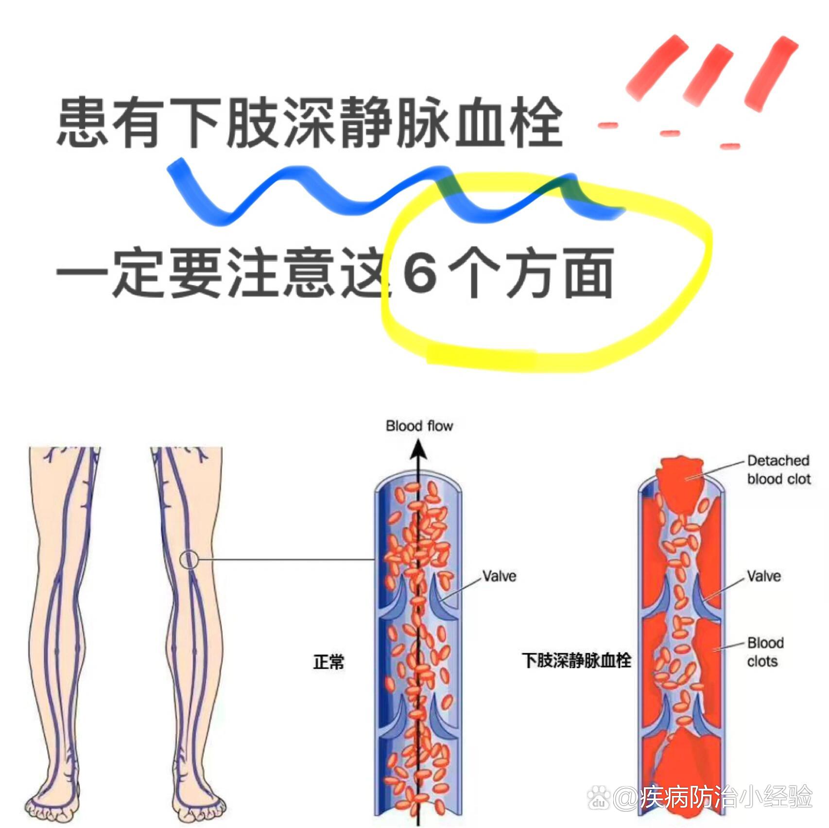 患有下肢深静脉血栓,一定要注意这6个方面!