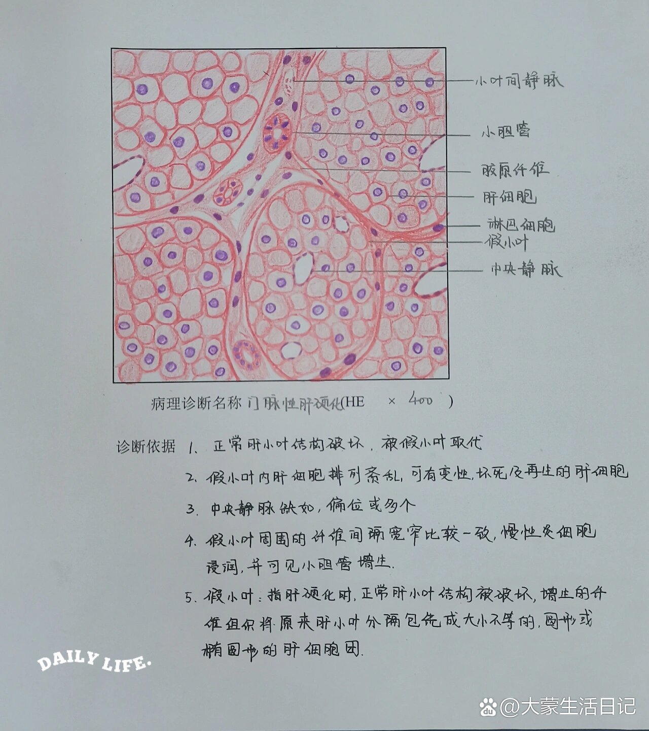 门脉性肝硬化