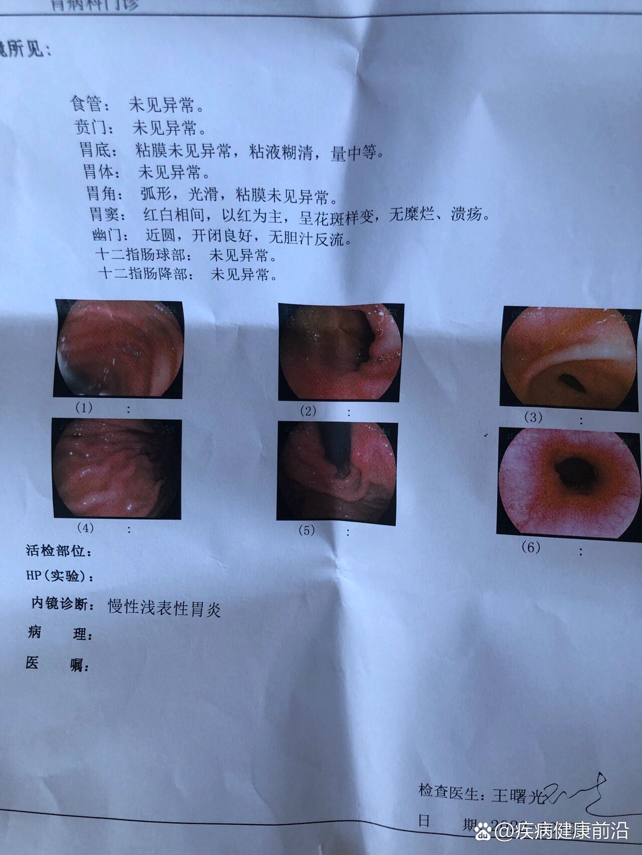 普通胃镜这辈子不想体会第二次做完直接吐血