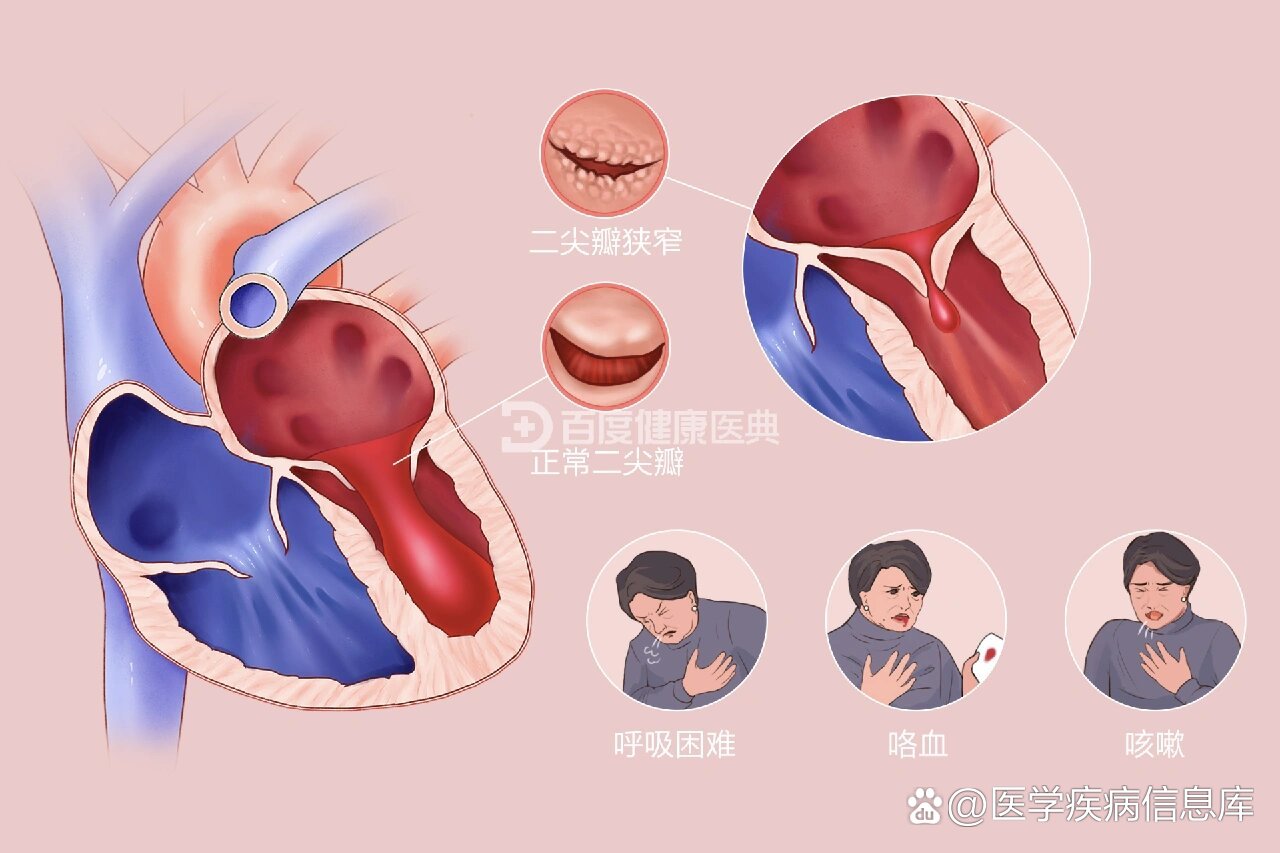 二尖瓣前叶冗长图片