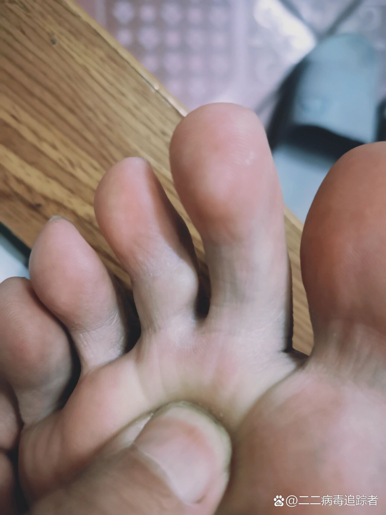 脚趾上长了个肉疙瘩,表面光滑,谁知道什么