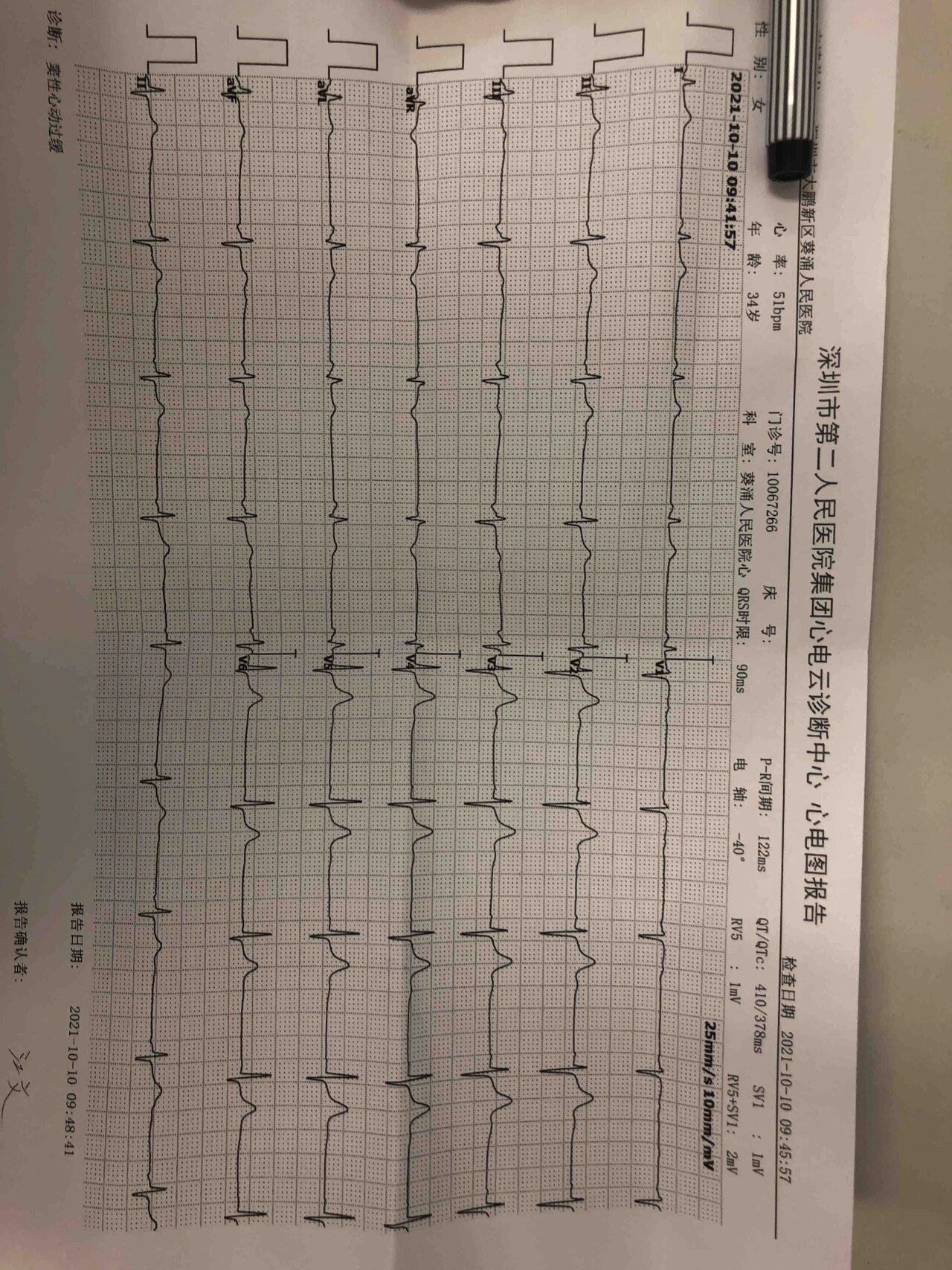 她说发现自己心动过缓已经很久了,每次心电图检查都是"窦性心动过