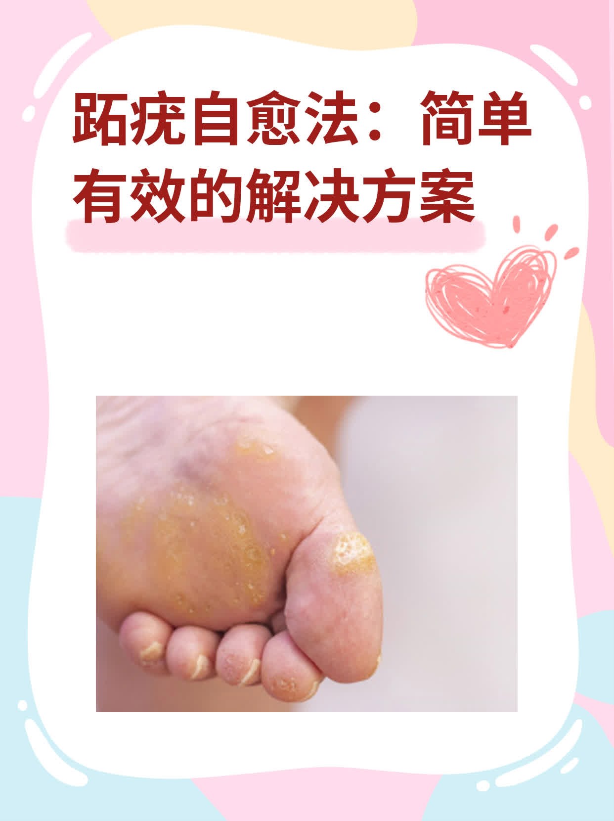 今天给大家分享一下身边的小杜是如何战胜跖疣的经历