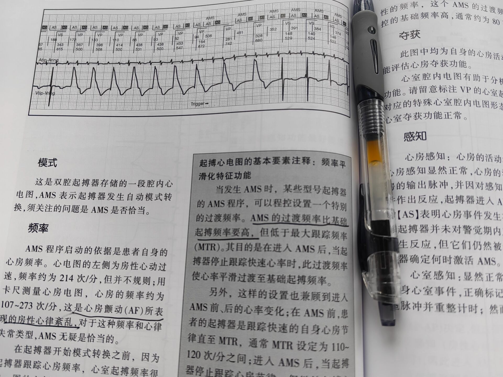 vvi起搏器心电图特点图片