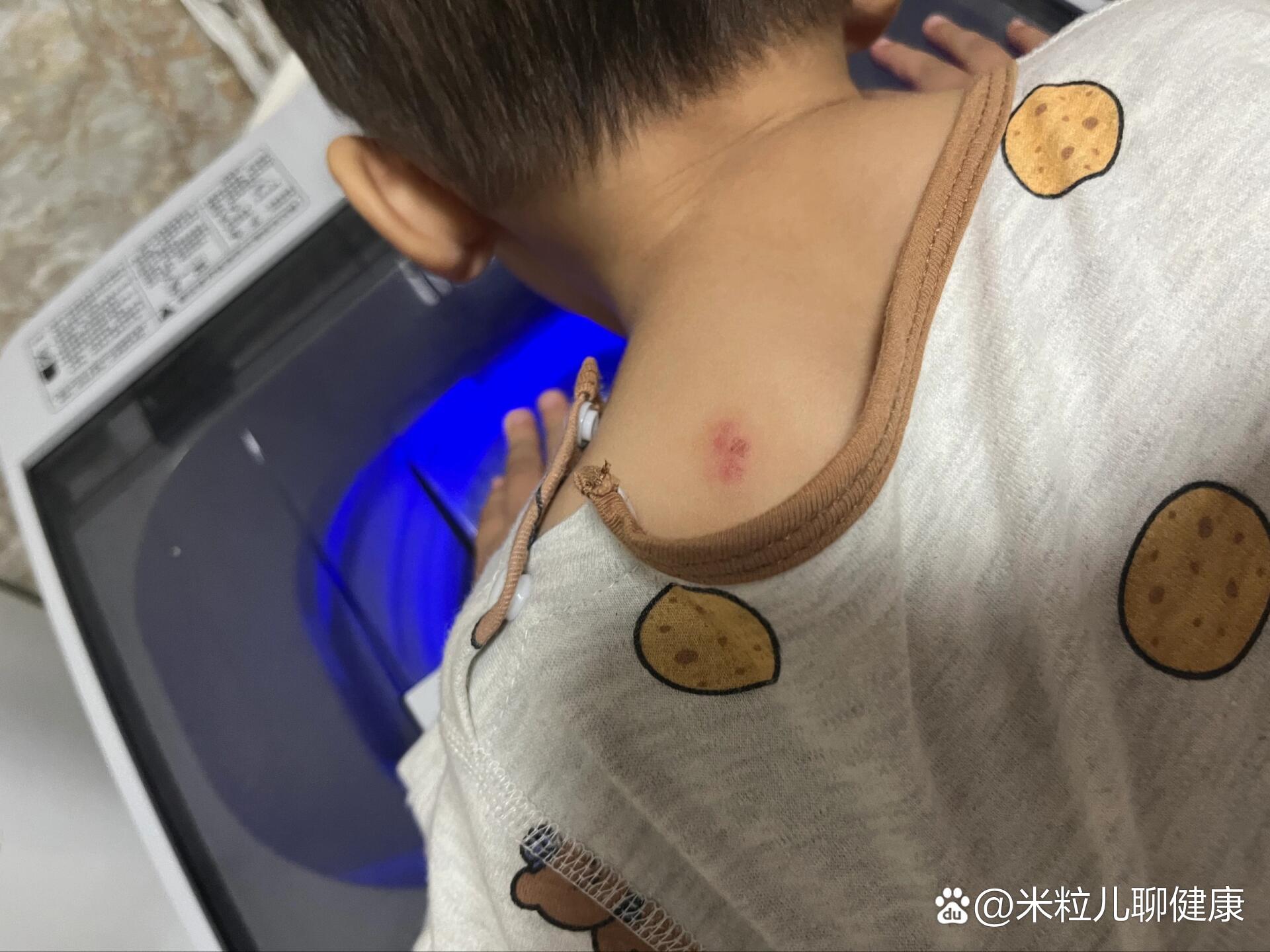 宝宝被别的小朋友咬了,用不用打破伤风