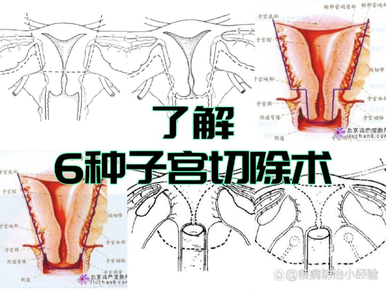 6种子宫切除手术