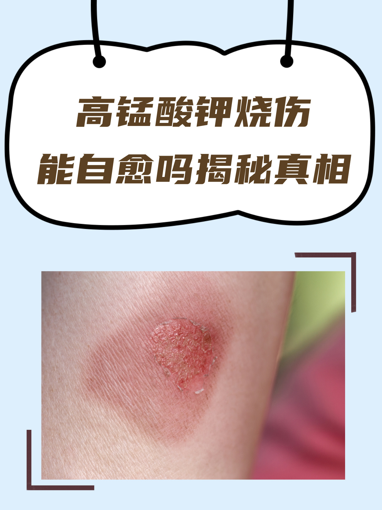 高锰酸钾烧伤,能自愈吗?揭秘真相!