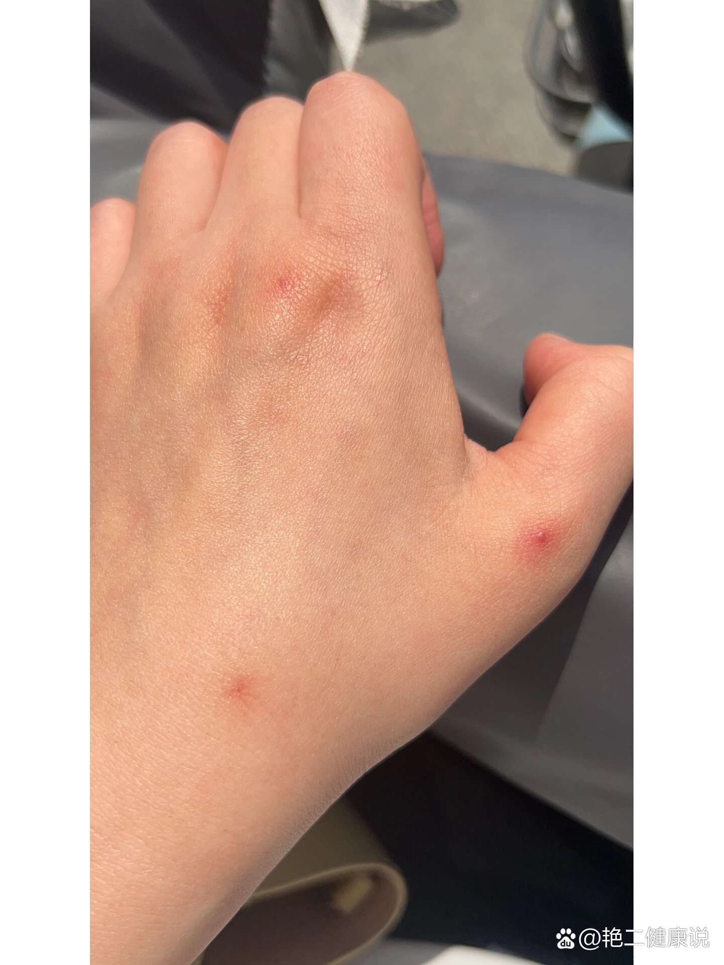 原来这是蜘蛛痣