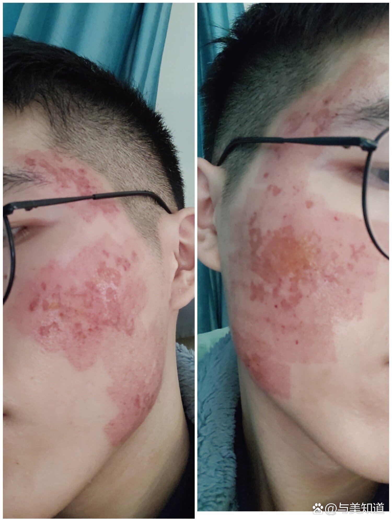 点阵激光术后十一天内变化