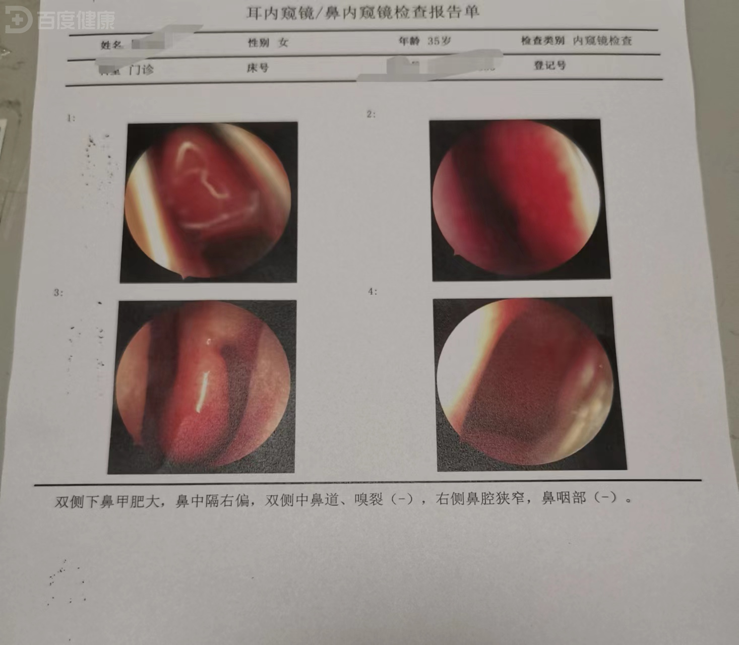 鼻甲肥大及时就医,药物治疗费用低