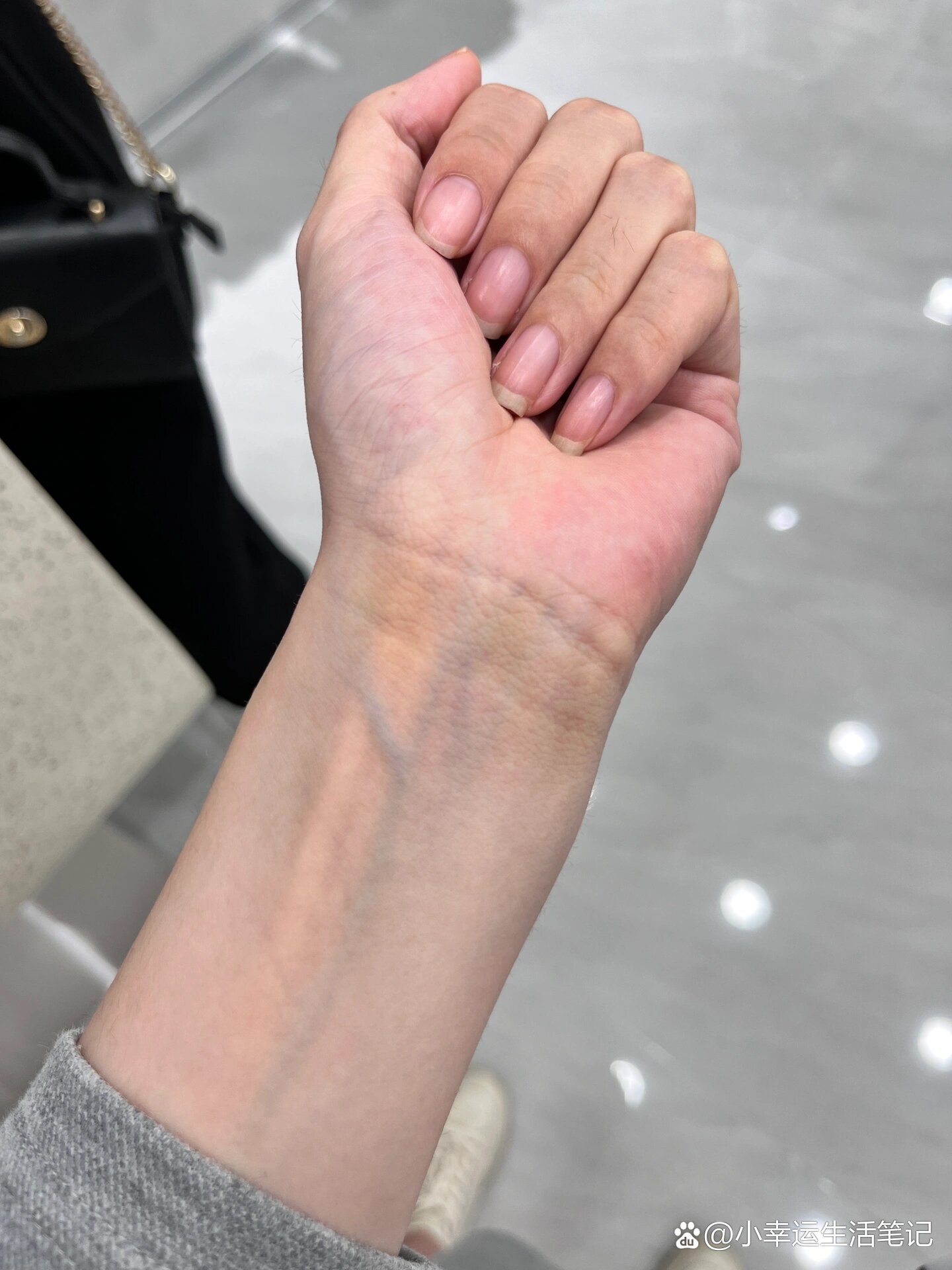 手腕突然出现淤青