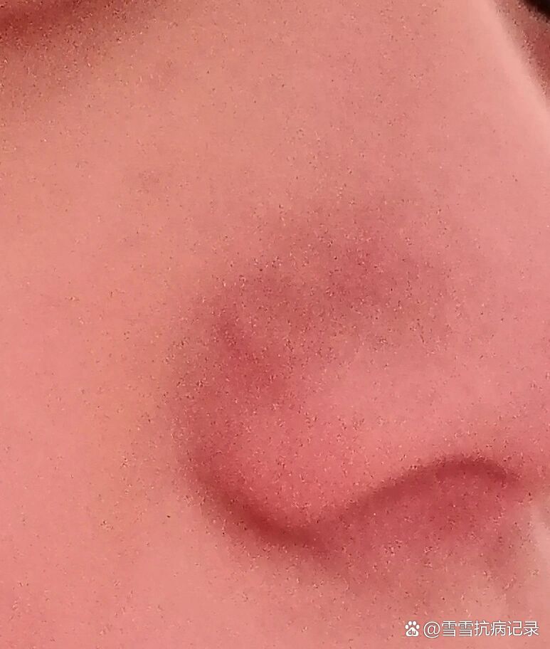 鼻子上有红血丝01