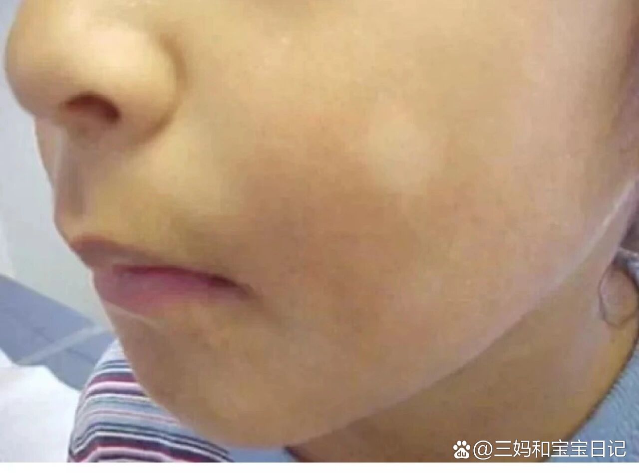 脸上一块一块的白斑,也叫积食冷饮斑,是孩子脾胃消化不好造成的