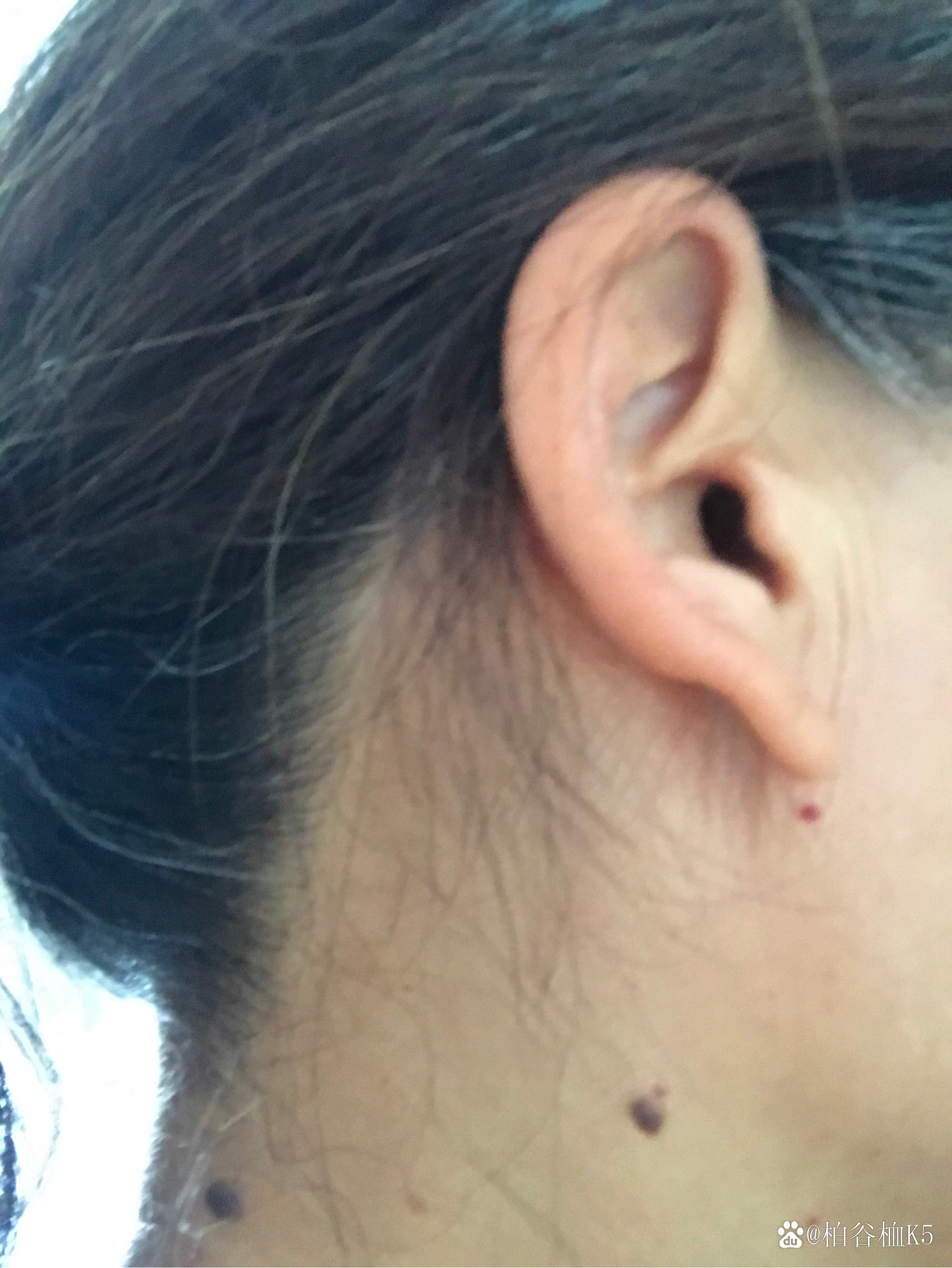 脖子的痣,是好,是坏?