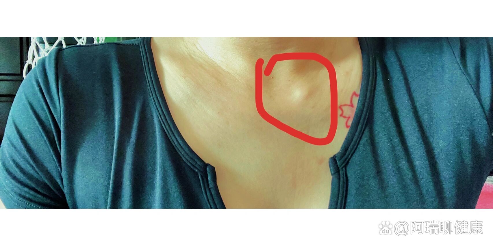  p>凸起 br>突然发现锁骨这儿有个凸起的,和骨头一样硬,按压不疼,有