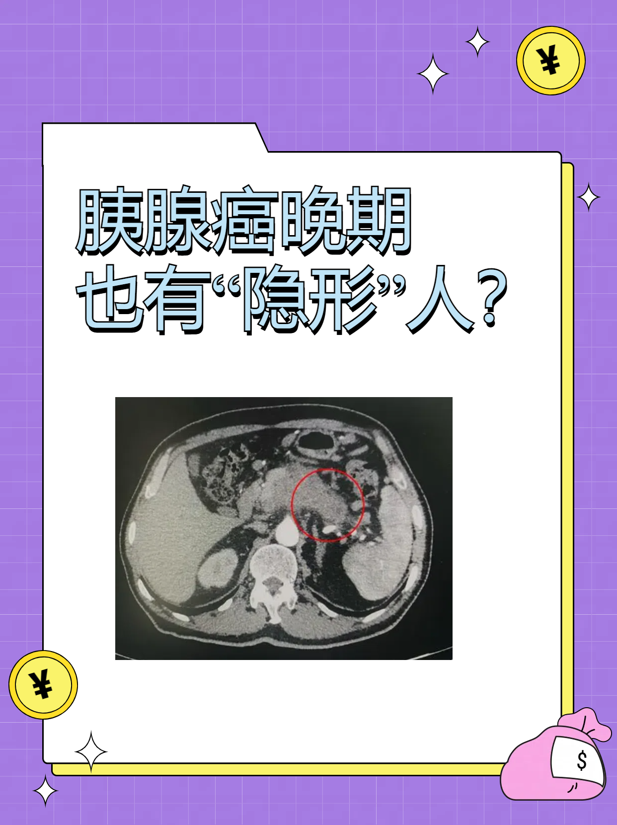  /p>  p>胰腺癌是一种高度恶性的肿瘤,其晚期症状可能包括黄疸,腹痛