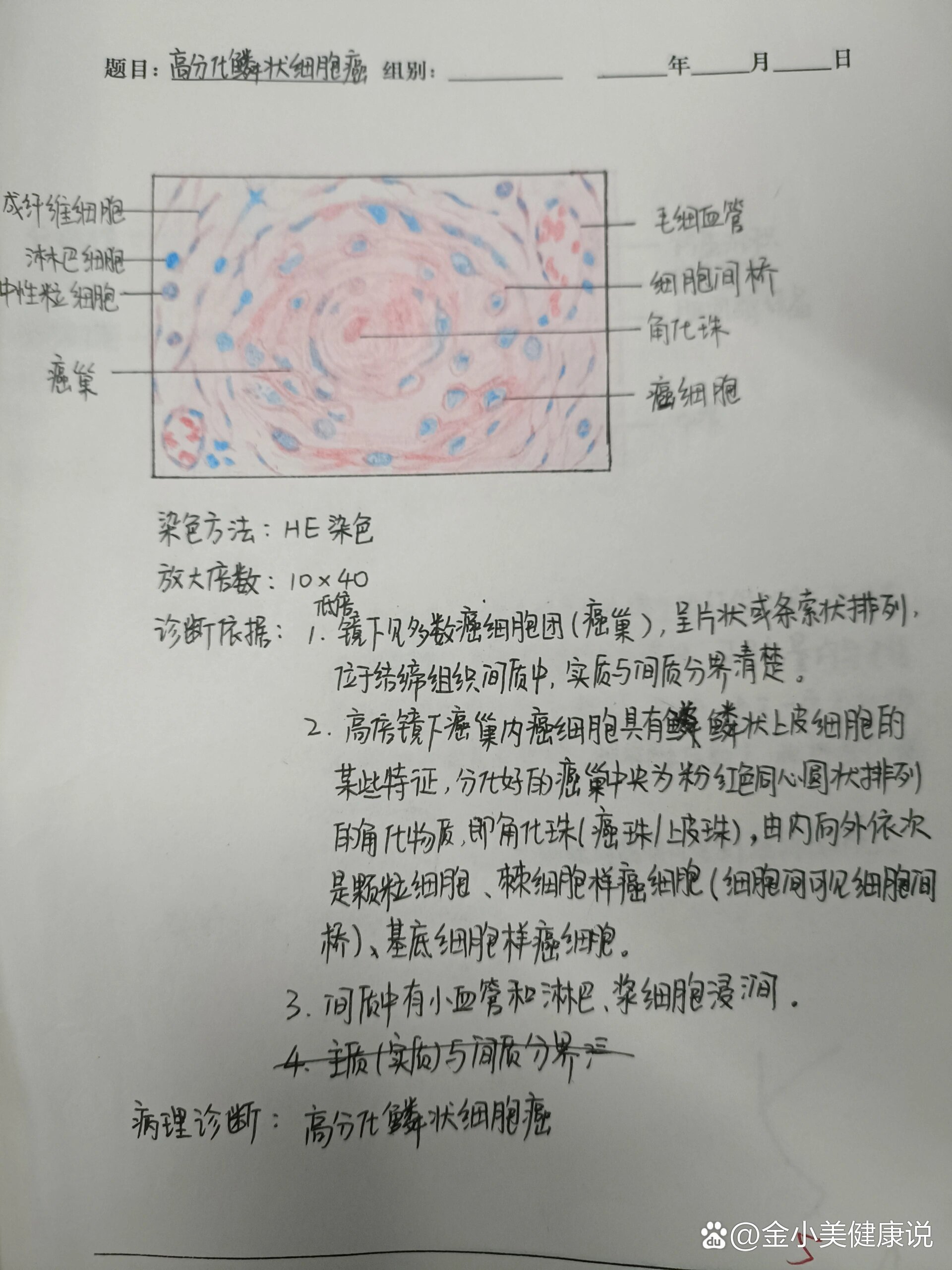 医学生绘图高分化鳞状细胞癌