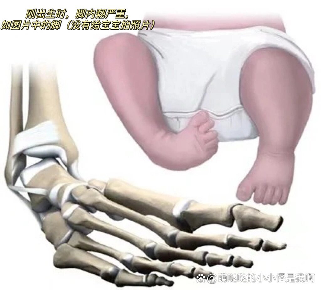 宝妈们,新生儿足内翻不必焦虑