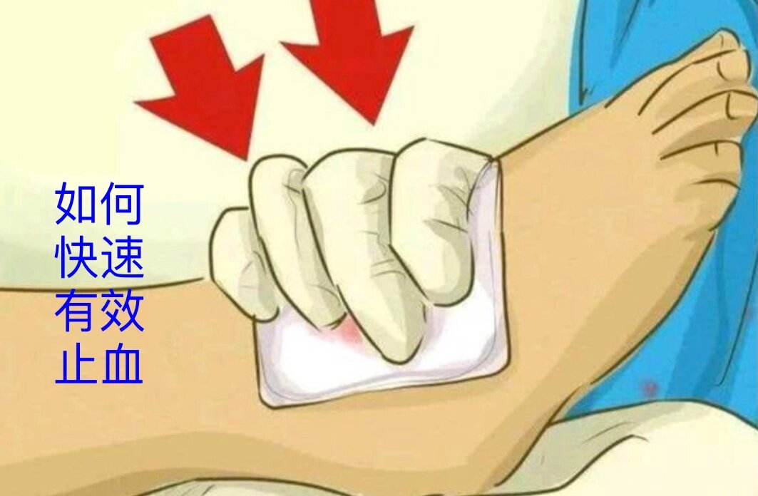 止血方法科普
