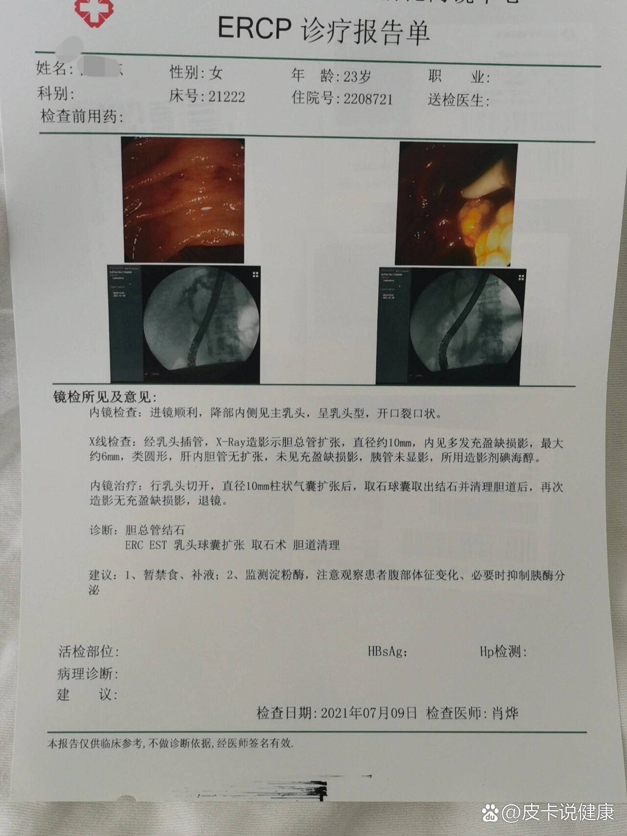 23岁因为胆总管多发结石,做了ercp手术