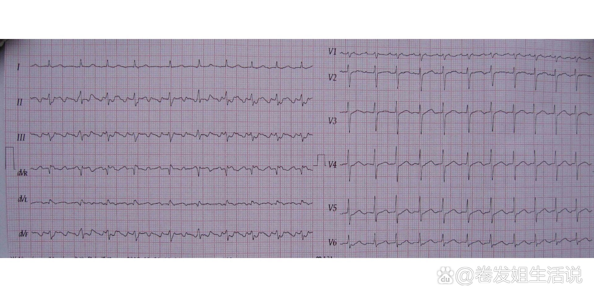 v3rv4rv5r导联心电图图片