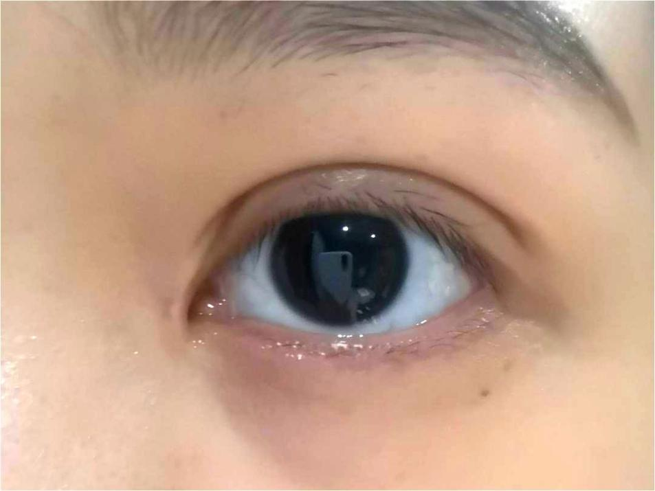 双眼皮术后褶皱分叉更丑了?医生:大部分是因为这6点!