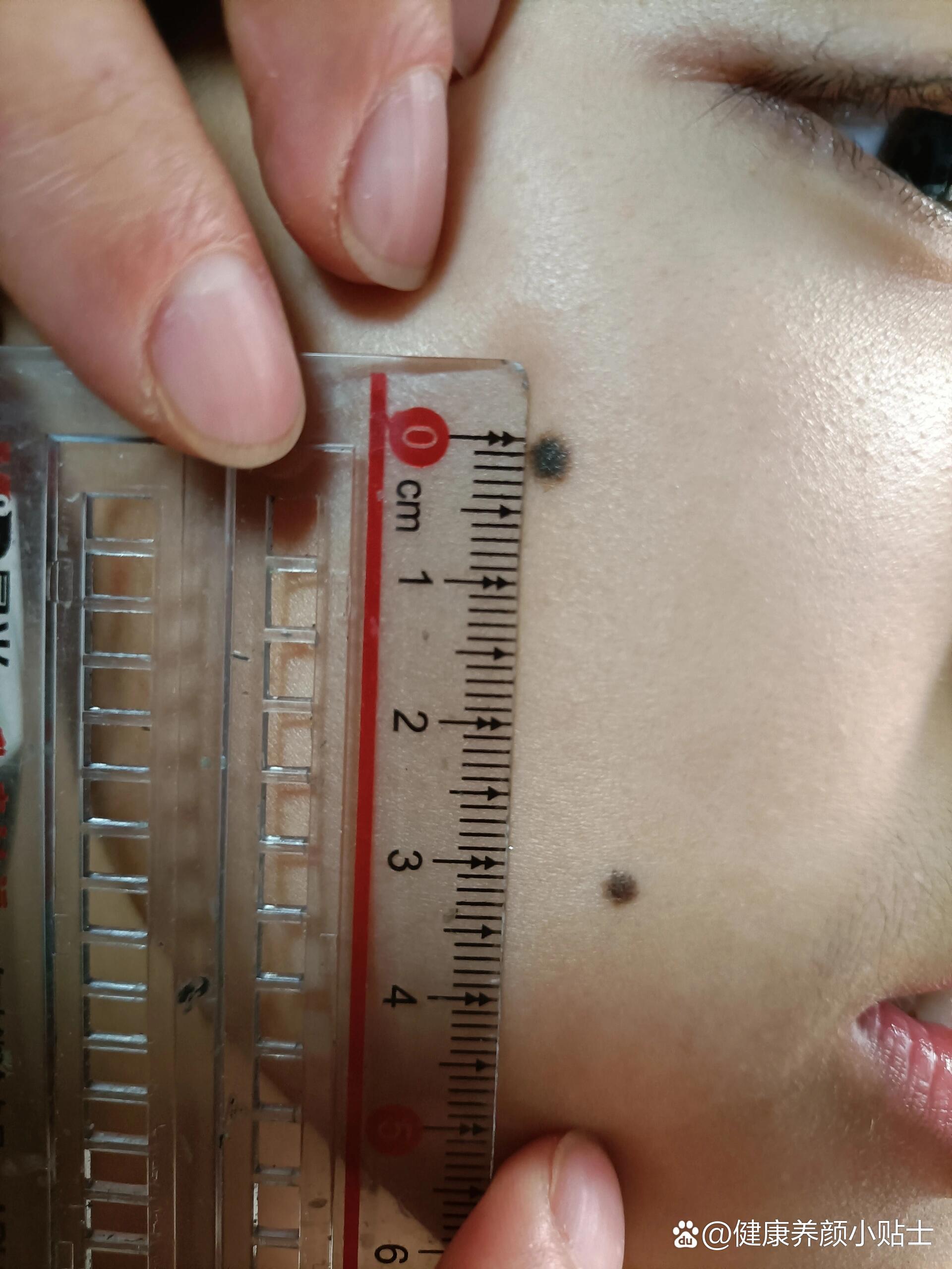 孩子14岁了,黑痣要不要尽早去除!