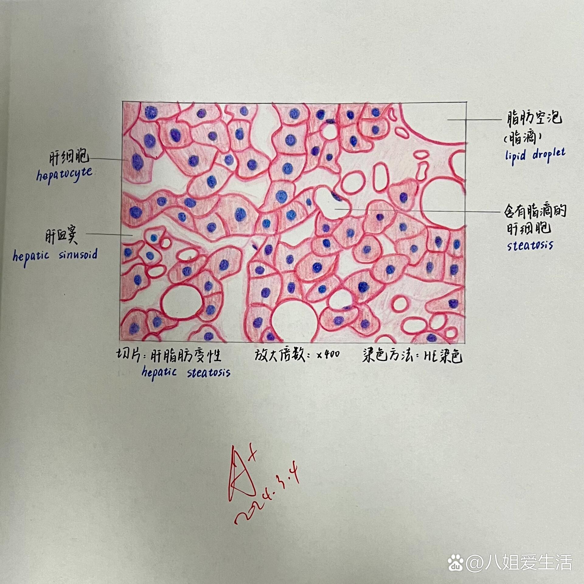 肝细胞脂肪变红蓝图片