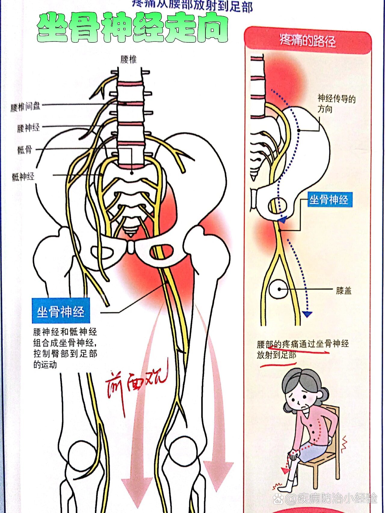 症状  br 坐骨神经痛呈现放射性