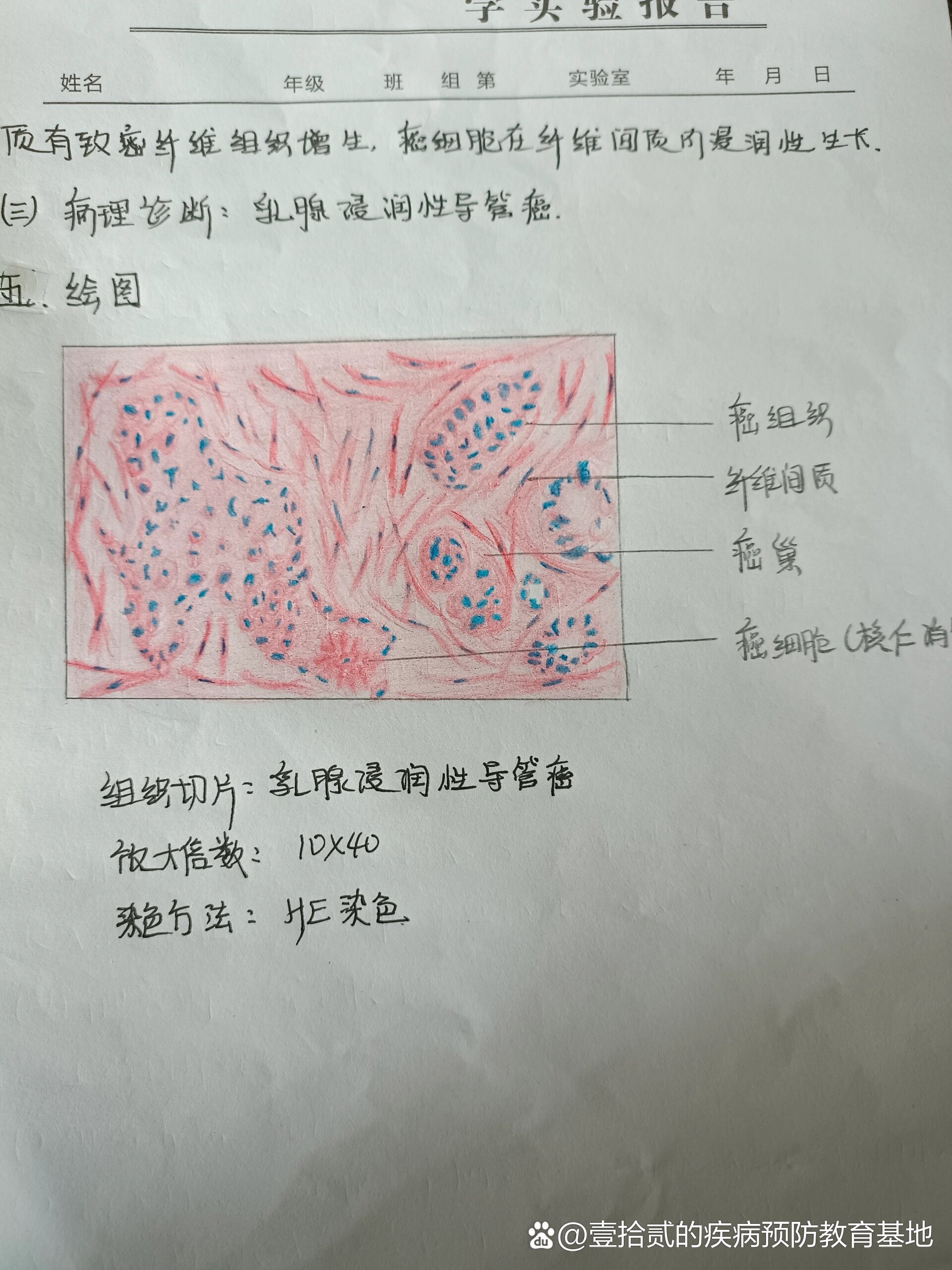 乳腺癌红蓝铅笔绘图图片