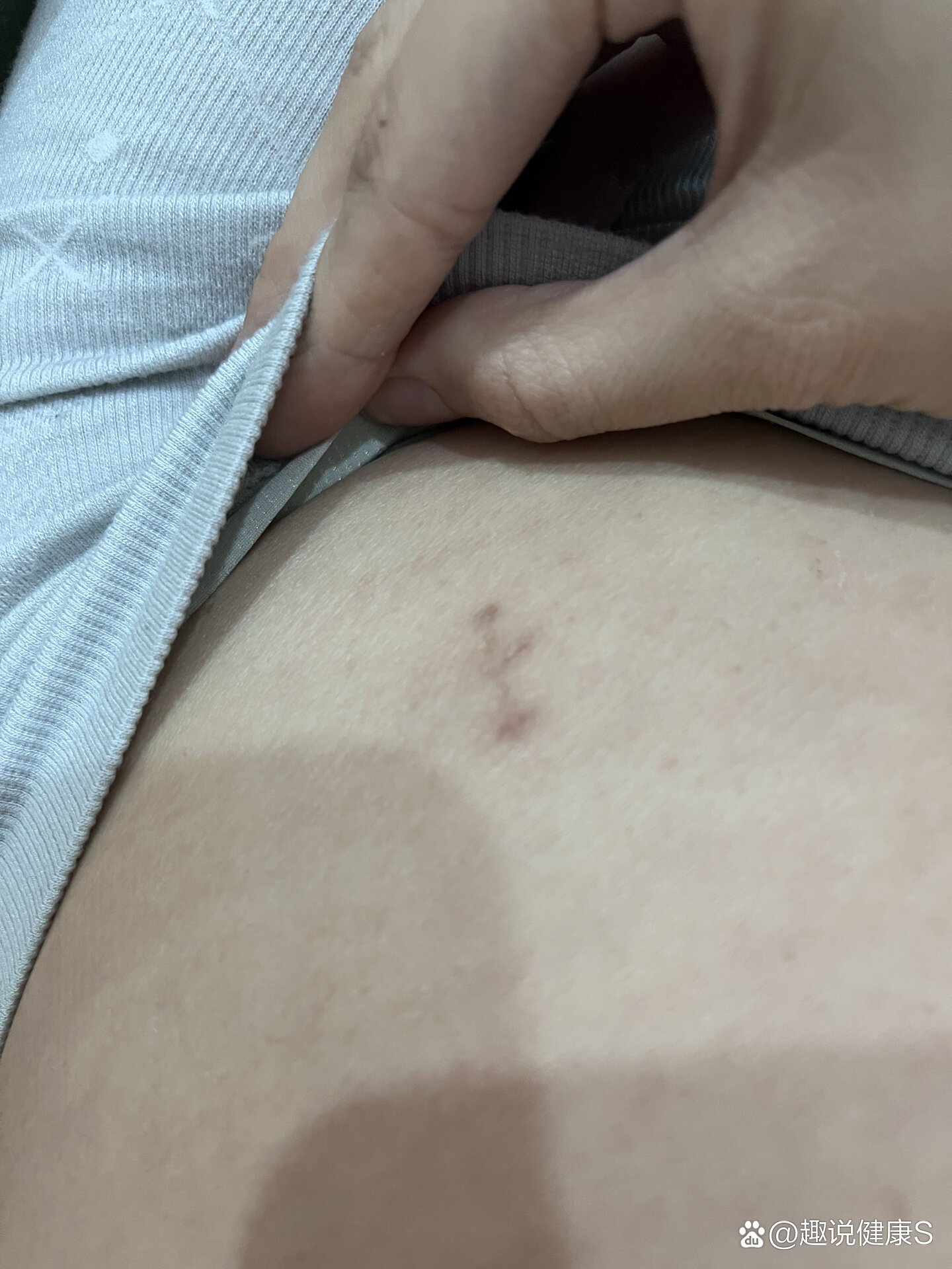 宫腹腔镜术后疤痕怎么消除